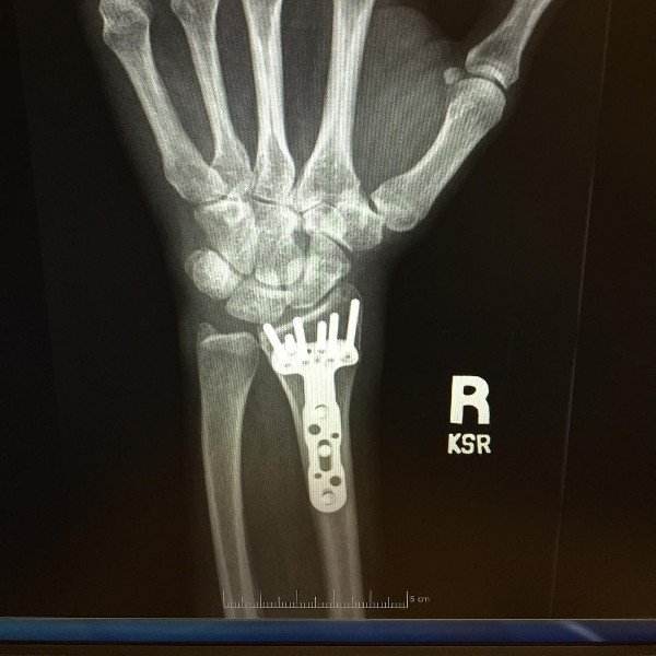 Behold Carrie Underwood's Wrist in All Its Glory
