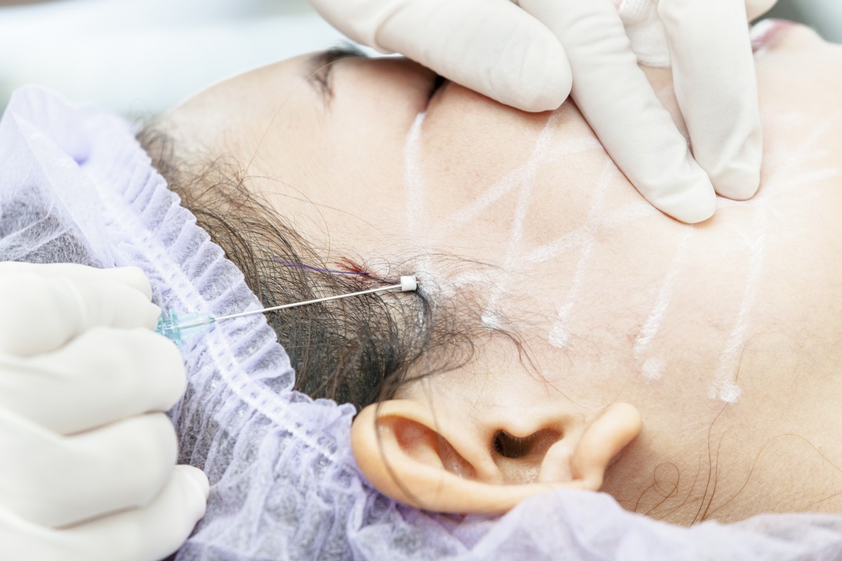 Understanding Thread Lifting: Is It Right for Your Face?